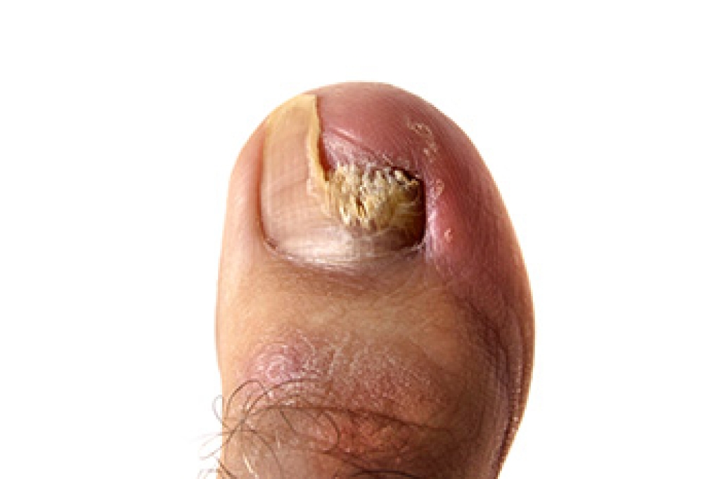 Thick Toenails and Fungal Infections