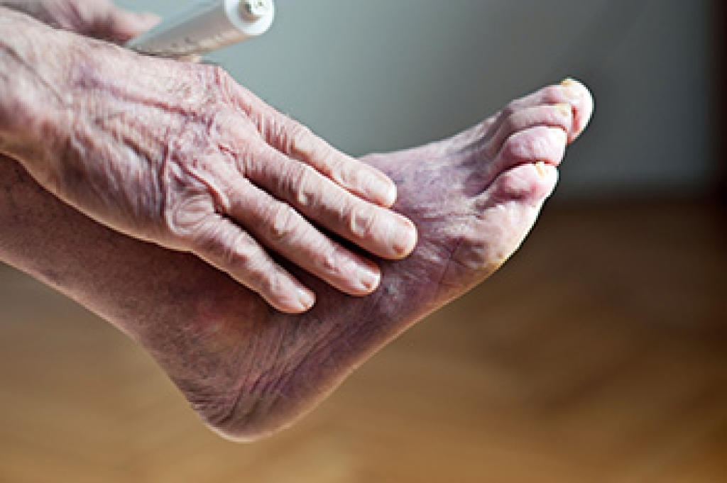 When Diabetes Reduces Blood Flow to the Feet