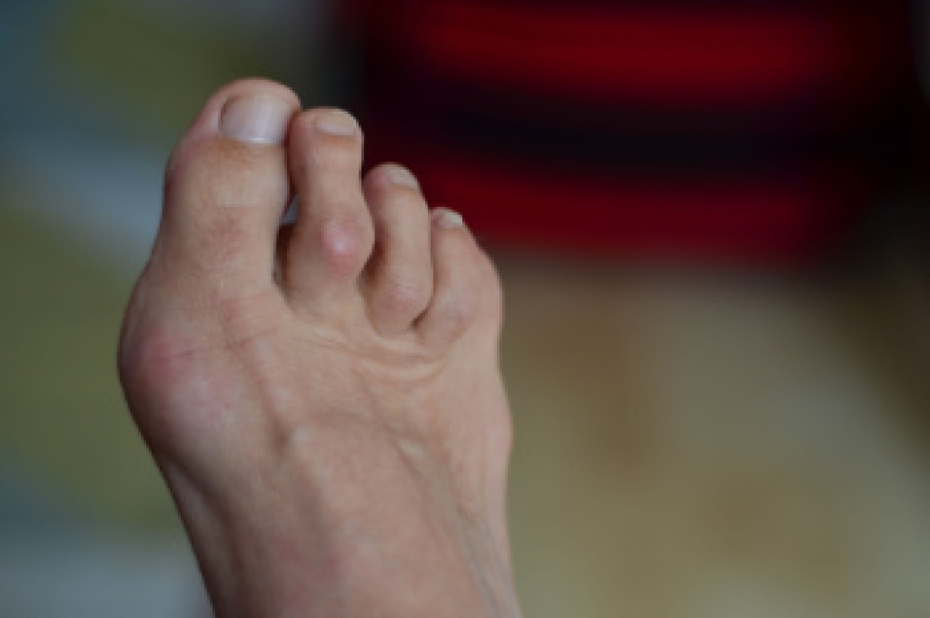Why Hammertoe Develops and How It Is Treated