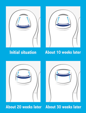 Onyfix Nail Correction System