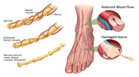 peripheral-neuropathy