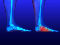 How Common Are Flat Feet?