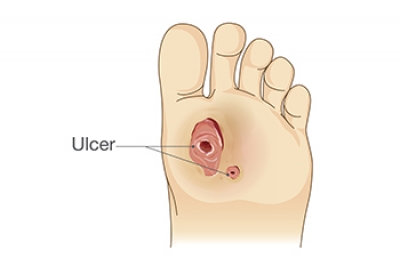 Stages of Diabetic Foot Ulcers