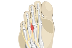What Your Foot May Be Telling You About Morton’s Neuroma