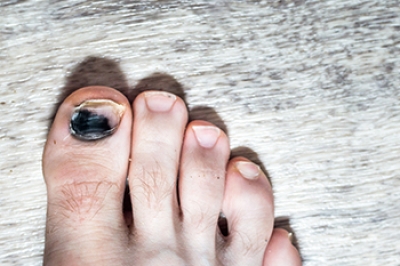 Causes of Black Toenails