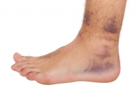 Causes of Ankle Sprains