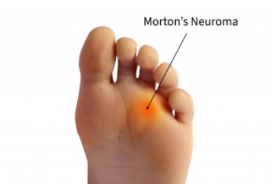 Essential Insights Into Morton's Neuroma